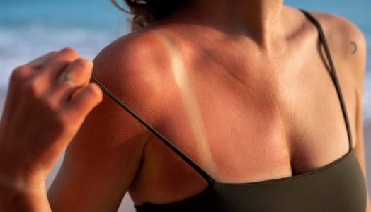 Di adiós a las quemaduras solares: Formas eficaces de aliviar el dolor y acelerar la curación
